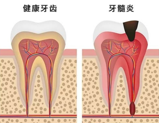 得了牙髓炎不治疗会怎有哪些后果？