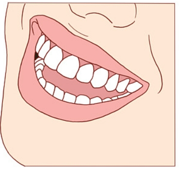 美学树脂修复牙缝的价格是多少？影响因素有哪些？