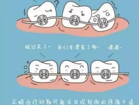 牙齿矫正用哪种牙套舒适？