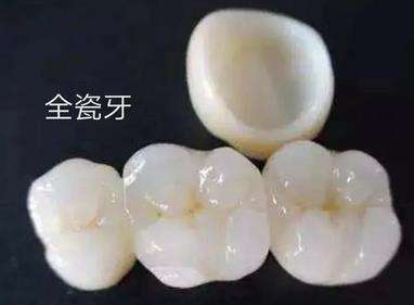 烤瓷牙和全瓷牙有哪些不同？