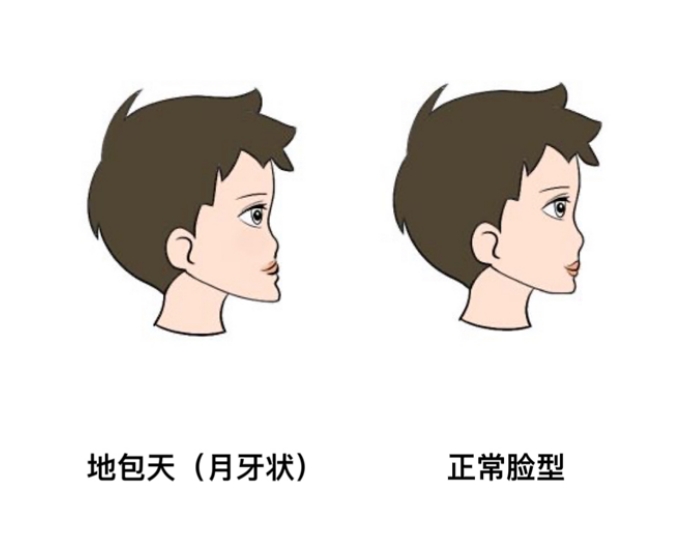地包天矫正需要手术吗，多长时间能好