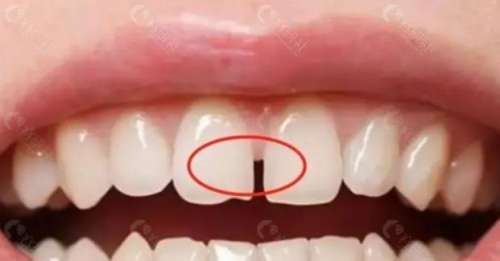 贴面和矫正哪个更适合门牙缝隙？