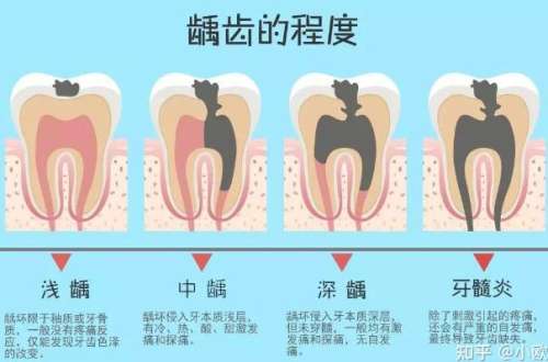 门牙浅龋要不要补？门牙浅龋的调节方法