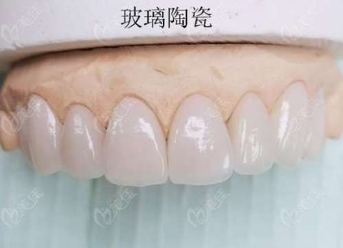 门牙缺损做贴面还是牙冠好？