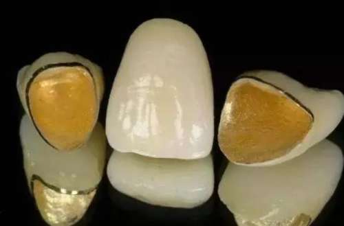 如何选择适合自己的金钯合金烤瓷牙调节方案？