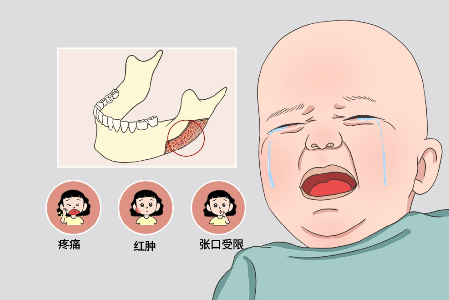 牙周炎早期有哪些容易被忽视的症状？