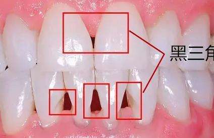 牙齿黑三角消除小妙招有哪些？