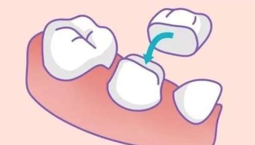 拔完智齿后的窟窿怎么办？怎么正确的护理？