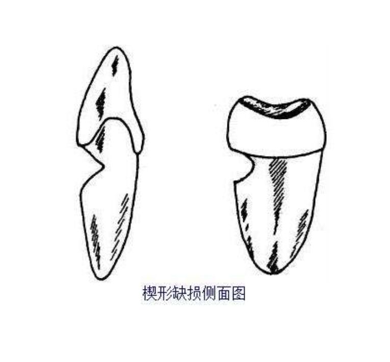 什么是楔状缺损？楔状缺损有什么危害？