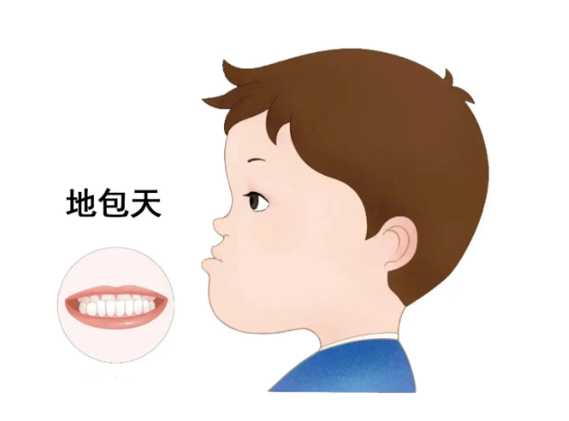 两岁宝宝出现地包天的症状该如何处理？