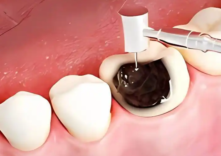 牙齿上黑洞，一定要补吗？