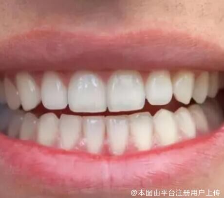 蛀牙做根管治疗后牙齿能使用多久？