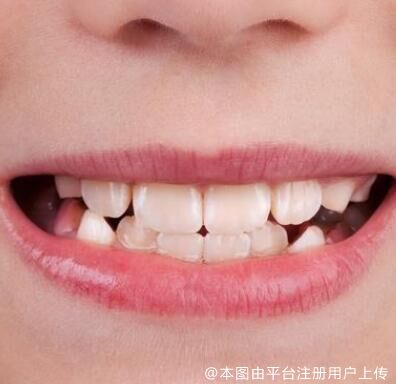 为什么新长出的恒牙，普遍比乳牙黄？